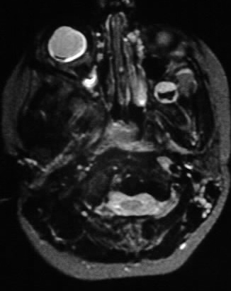 Trilateral Retinoblastoma